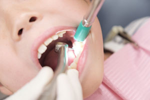 小児の虫歯予防